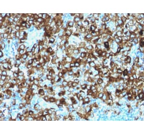 Immunohistochemistry - Anti-Melanoma gp100 Antibody (A249976) - Antibodies.com