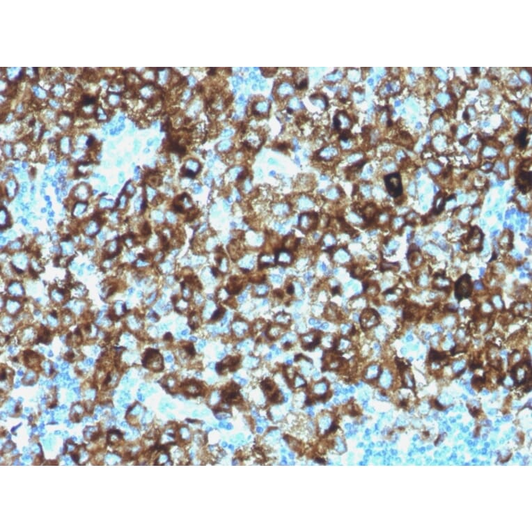 Immunohistochemistry - Anti-Melanoma gp100 Antibody (A249976) - Antibodies.com