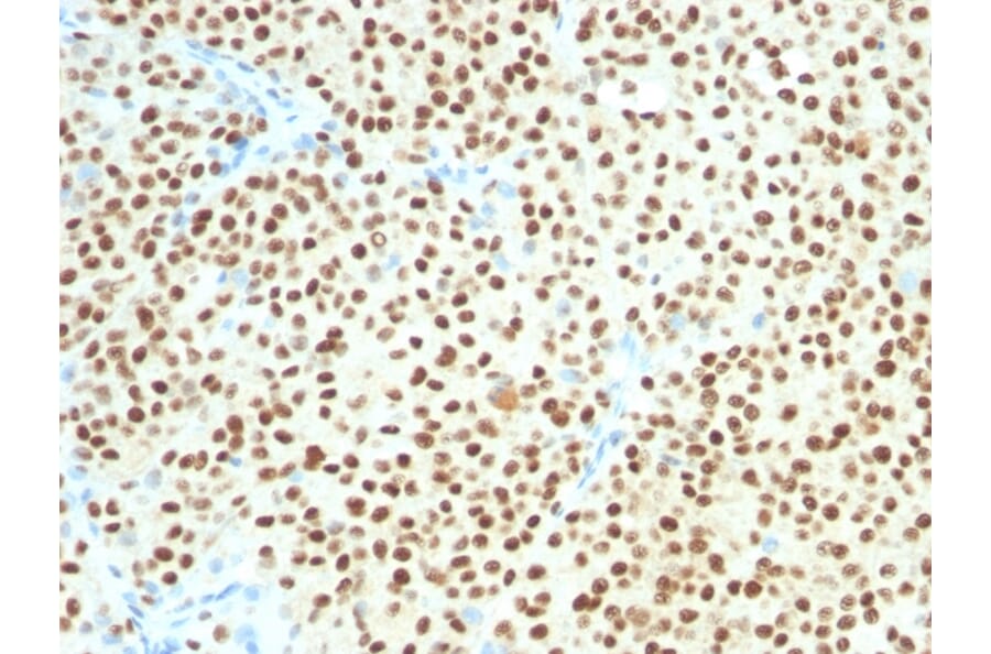 Immunohistochemistry - Anti-SOX10 Antibody [SOX10/1074] (A250015) - Antibodies.com