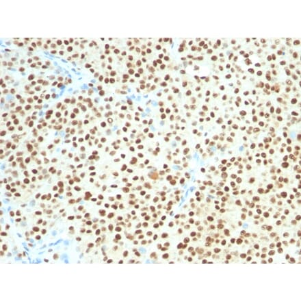 Immunohistochemistry - Anti-SOX10 Antibody [SOX10/1074] (A250015) - Antibodies.com