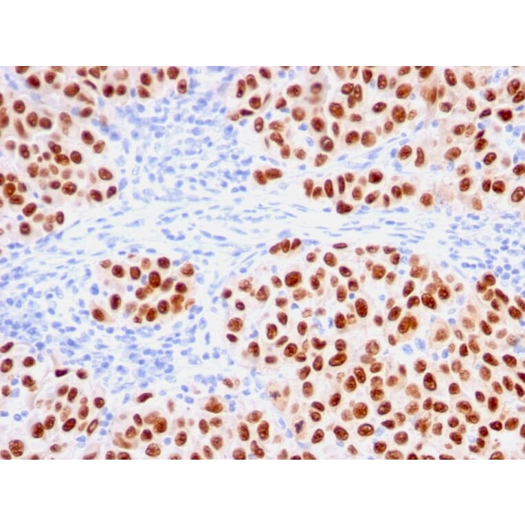 Immunohistochemistry - Anti-SOX10 Antibody [rSOX10/1074] (A250017) - Antibodies.com