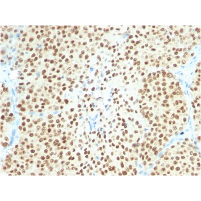 Immunohistochemistry - Anti-SOX10 Antibody [SOX10/2311R] (A250019) - Antibodies.com