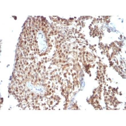 Immunohistochemistry - Anti-p53 Antibody [SPM590] (A250180) - Antibodies.com