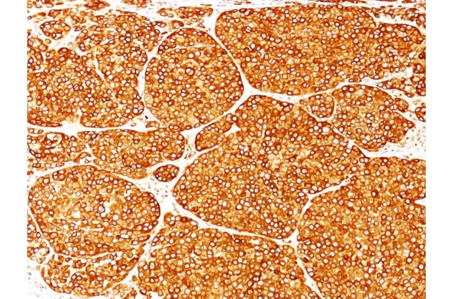 Immunohistochemistry - Anti-Tyrosinase Antibody [T311] (A250239) - Antibodies.com