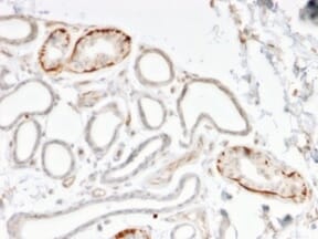 Immunohistochemical analysis of formalin-fixed, paraffin-embedded human breast carcinoma using Anti-GTF2H2C Antibody [PCRP-GTF2H2C-2C9].