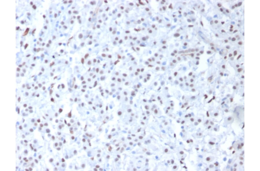Immunohistochemistry - Anti-Wilms Tumor Protein Antibody [6F-H2] (A250329) - Antibodies.com