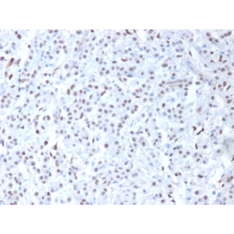 Immunohistochemistry - Anti-Wilms Tumor Protein Antibody [6F-H2] (A250329) - Antibodies.com