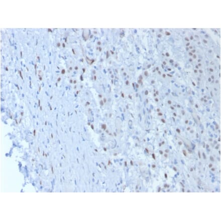 Immunohistochemistry - Anti-Wilms Tumor Protein Antibody [SPM361] (A250330) - Antibodies.com