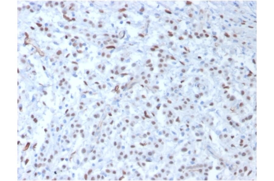 Immunohistochemistry - Anti-Wilms Tumor Protein Antibody [WT1/857] (A250331) - Antibodies.com