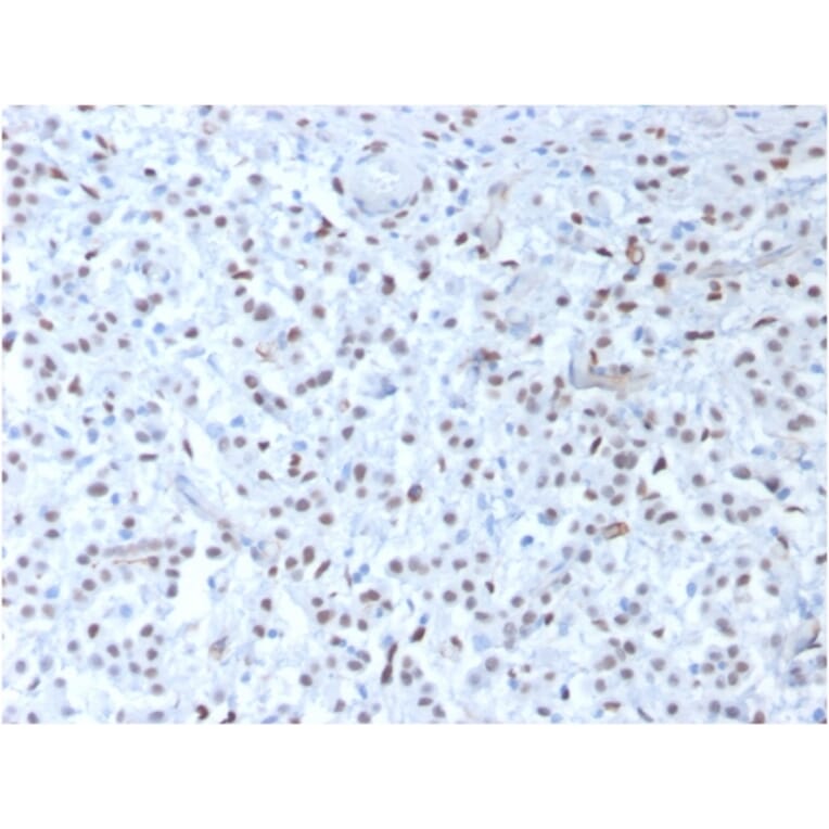 Immunohistochemistry - Anti-Wilms Tumor Protein Antibody [rWT1/857] (A250334) - Antibodies.com