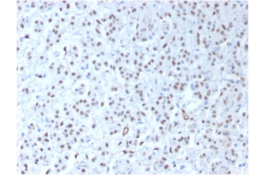 Immunohistochemistry - Anti-Wilms Tumor Protein Antibody [WT1/1434R] (A250334) - Antibodies.com