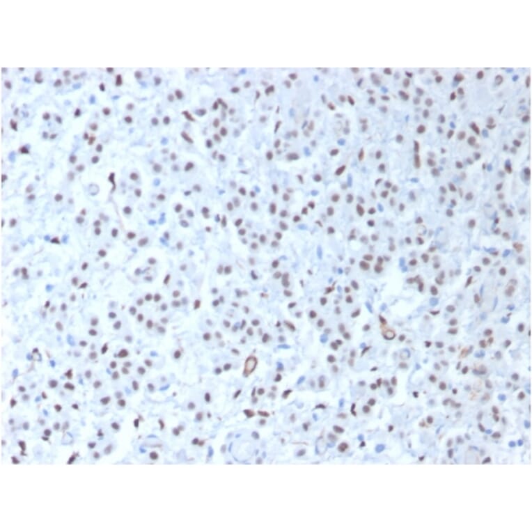 Immunohistochemistry - Anti-Wilms Tumor Protein Antibody [WT1/1434R] (A250334) - Antibodies.com