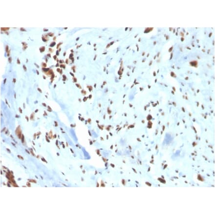 Immunohistochemistry - Anti-Wilms Tumor Protein Antibody [WT1/3477R] (A250335) - Antibodies.com