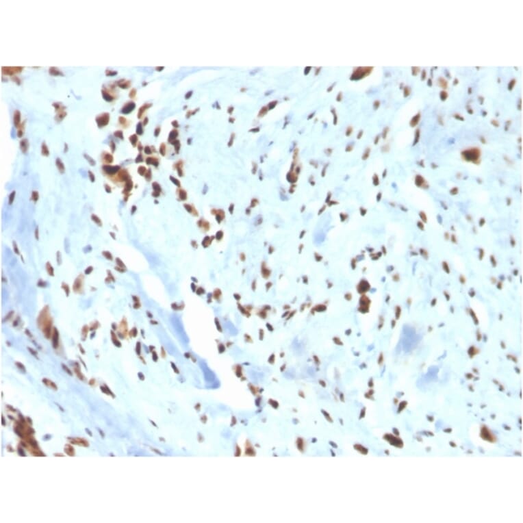 Immunohistochemistry - Anti-Wilms Tumor Protein Antibody [WT1/3477R] (A250335) - Antibodies.com