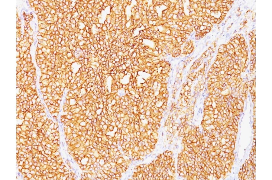 Immunohistochemistry - Anti-Carbonic Anhydrase IX Antibody [SPM487] (A250352) - Antibodies.com