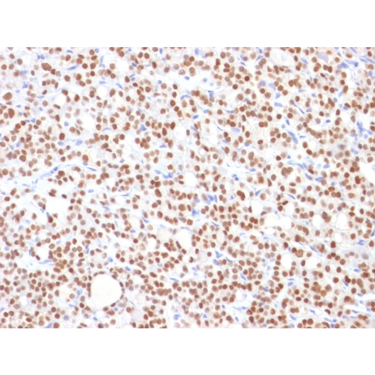 Immunohistochemistry - Anti-PAX8 Antibody [PAX8/1492] (A250361) - Antibodies.com