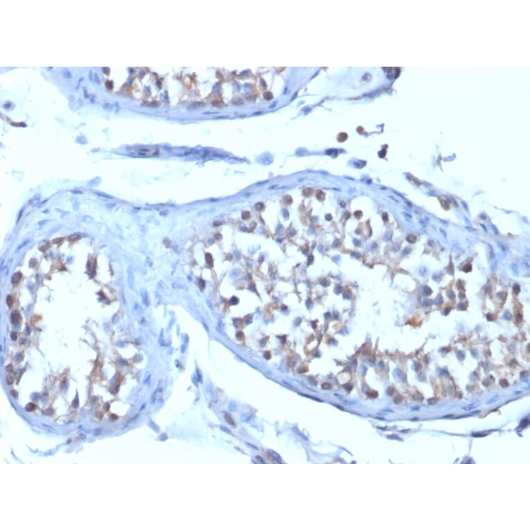 Immunohistochemistry - Anti-B7H4 Antibody [B7H4/1788] (A250377) - Antibodies.com