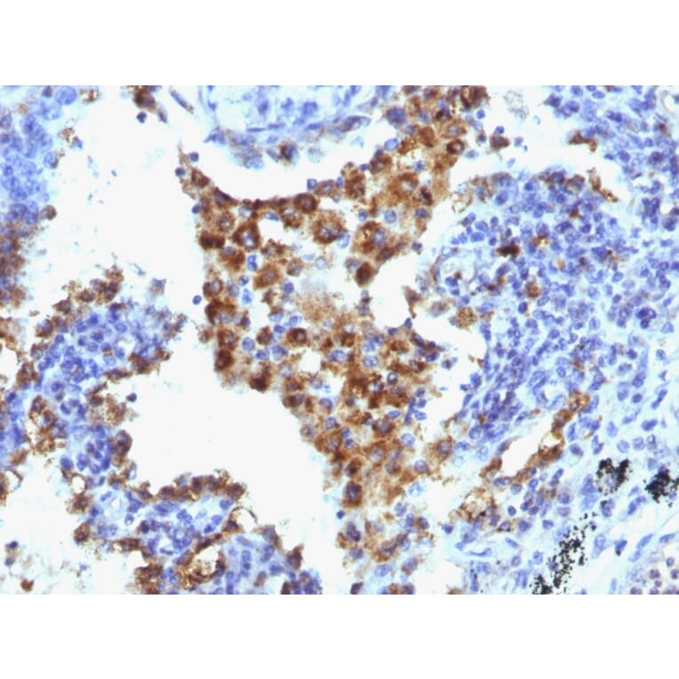 Immunohistochemistry - Anti-NAPSIN A Antibody [NAPSA/1238 + NAPSA/1239] (A250668) - Antibodies.com