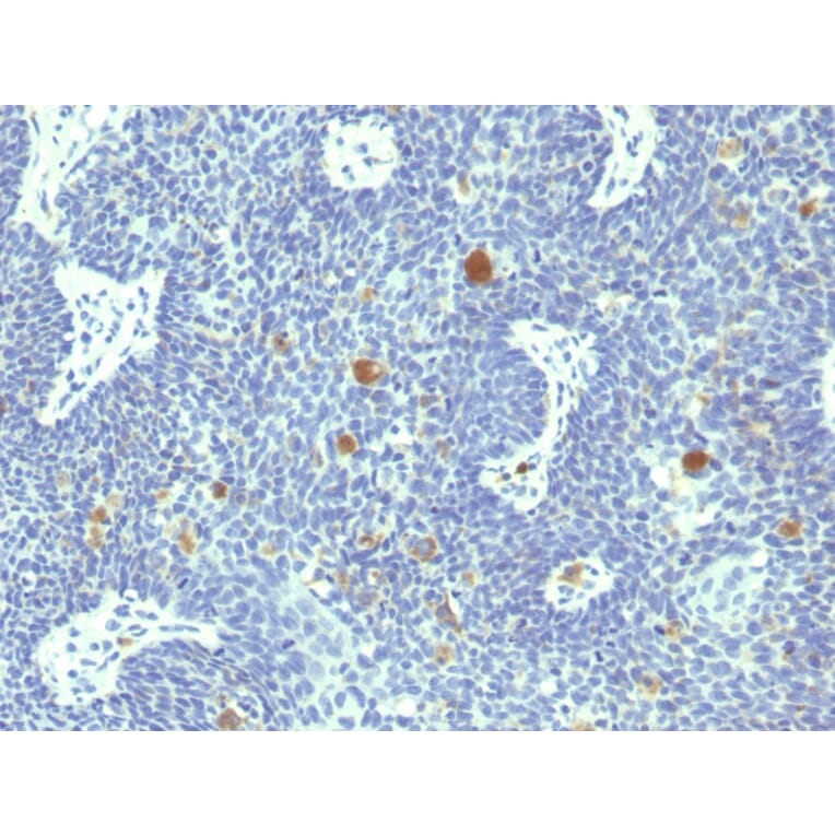 Immunohistochemistry - Anti-HPV-18 Antibody [HPV18/1297] (A250845) - Antibodies.com