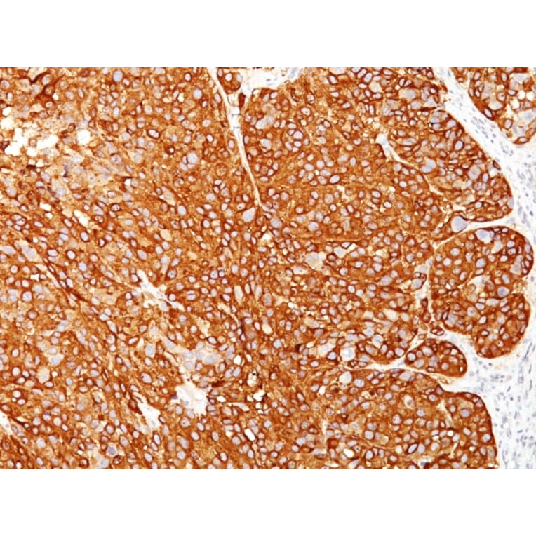 Immunohistochemistry - Anti-Melanoma Marker (MART-1 + Tyrosinase + gp100) Antibody [M2-7C10 + M2-9E3 + T311 + HMB45] (A250889) - Antibodies.com