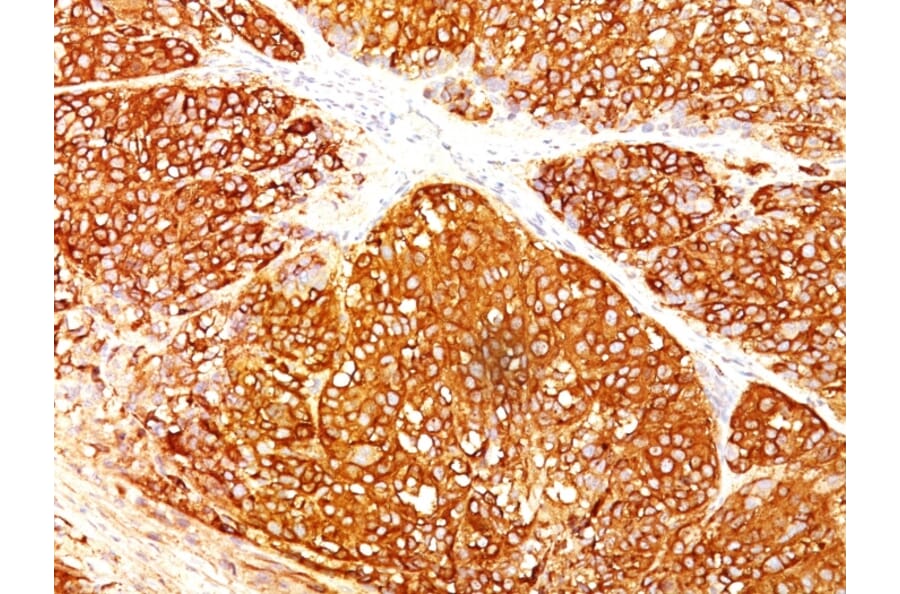Immunohistochemistry - Anti-Melanoma Marker (MART-1 + Tyrosinase + gp100) Antibody [A103 + T311 + HMB45] (A250931) - Antibodies.com