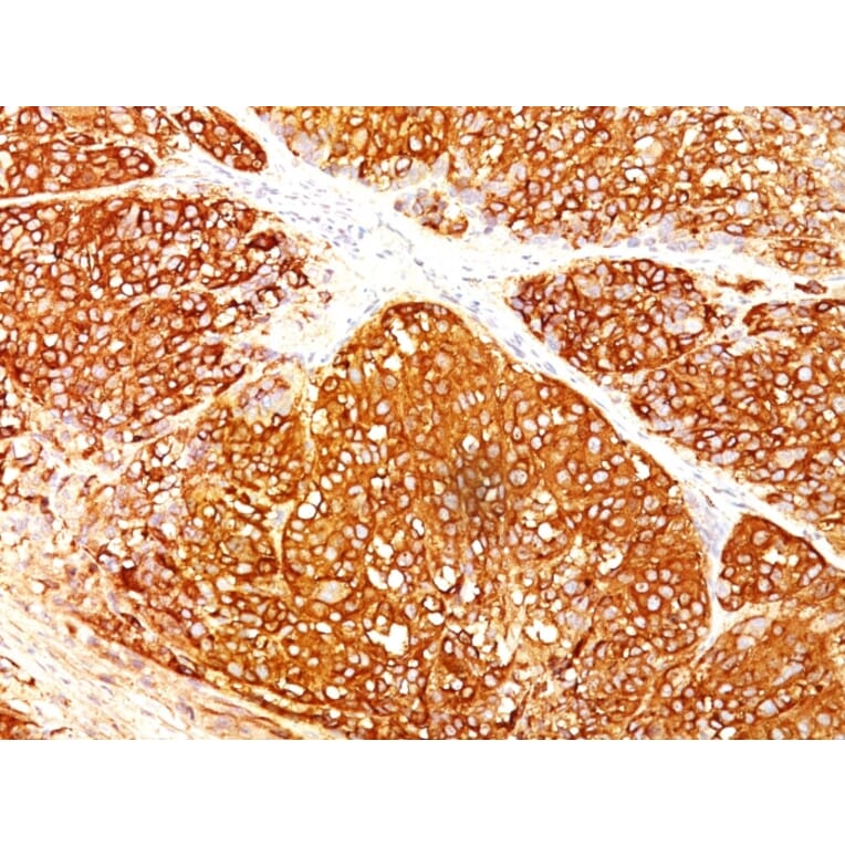 Immunohistochemistry - Anti-Melanoma Marker (MART-1 + Tyrosinase + gp100) Antibody [A103 + T311 + HMB45] (A250931) - Antibodies.com