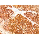 Immunohistochemistry - Anti-Melanoma Marker (MART-1 + Tyrosinase + gp100) Antibody [A103 + T311 + HMB45] (A250931) - Antibodies.com