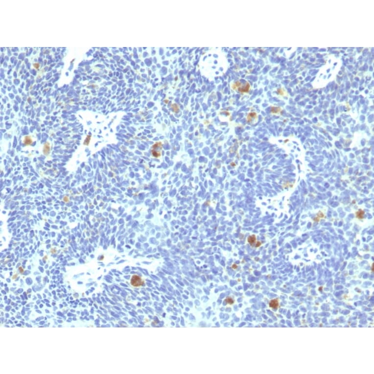 Immunohistochemistry - Anti-HPV16 E6 Antibody [HPV16/1295] (A250948) - Antibodies.com