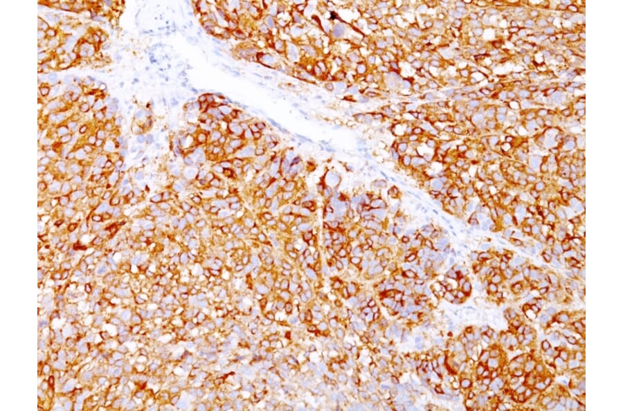 Immunohistochemistry - Anti-Melanoma Marker (MART-1 + gp100) Antibody [DT101+ BC199 + HMB45] (A250961) - Antibodies.com