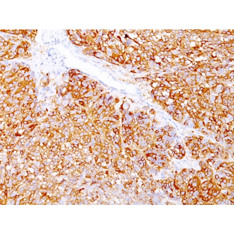 Immunohistochemistry - Anti-Melanoma Marker (MART-1 + gp100) Antibody [DT101+ BC199 + HMB45] (A250961) - Antibodies.com