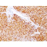 Immunohistochemistry - Anti-Melanoma Marker (MART-1 + gp100) Antibody [DT101+ BC199 + HMB45] (A250961) - Antibodies.com