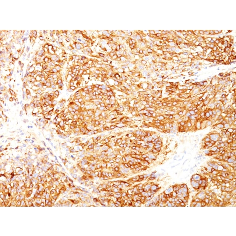 Immunohistochemistry - Anti-Melanoma Marker (MART-1 + gp100) Antibody [DT101+ BC199 + HMB45] (A250960) - Antibodies.com