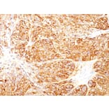 Immunohistochemistry - Anti-Melanoma Marker (MART-1 + gp100) Antibody [DT101+ BC199 + HMB45] (A250960) - Antibodies.com