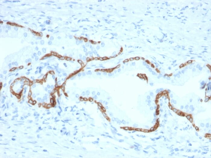 Immunohistochemical analysis of formalin-fixed, paraffin-embedded human prostate carcinoma using Anti-Cytokeratin 5 + 6 Antibody [KRT5.6/2438].