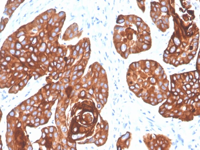 Immunohistochemical analysis of formalin-fixed, paraffin-embedded human squamous cell carcinoma using Anti-Cytokeratin 5 + 6 Antibody [KRT5.6/4866].