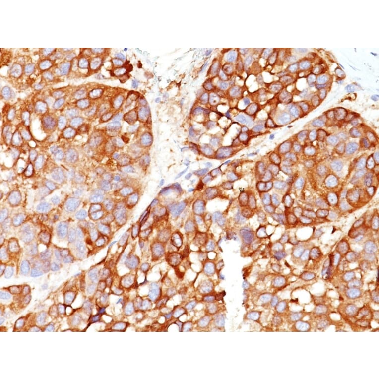 Immunohistochemistry - Anti-Melanoma Marker (MART-1 + Tyrosinase + gp100) Antibody [DT101+ BC199 + T311 + HMB45] (A250975) - Antibodies.com