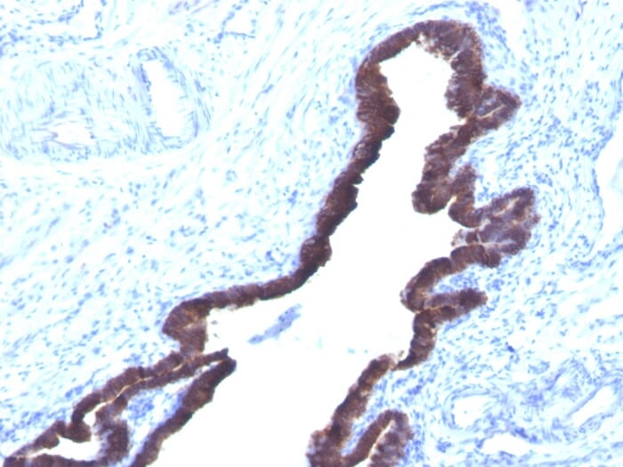 Immunohistochemical analysis of formalin-fixed, paraffin-embedded human ovarian cancer using Anti-Cytokeratin 8 + 18 Antibody [K8.8 + DC10].