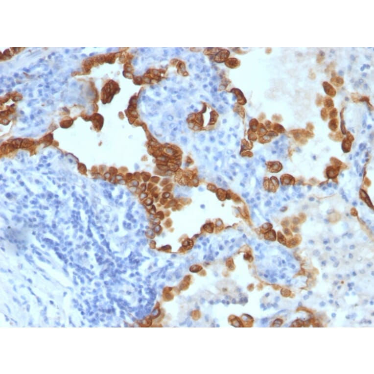 Immunohistochemistry - Anti-Cytokeratin 8 + 18 Antibody [SPM192 + SPM265] (A254174) - Antibodies.com