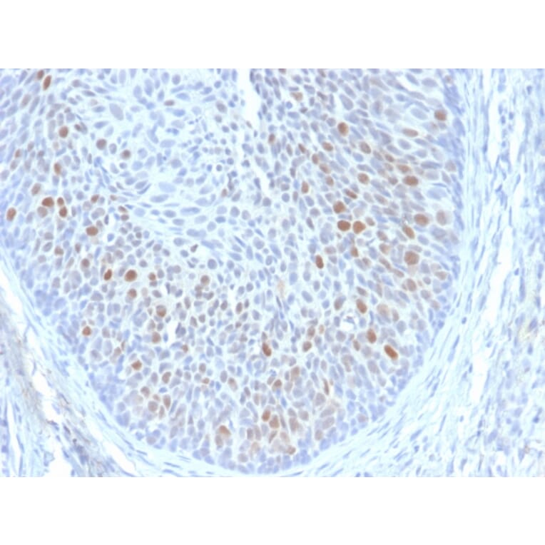 Immunohistochemistry - Anti-HPV16 E1 + E4 Antibody [HPV16 E1/E4] (A251003) - Antibodies.com