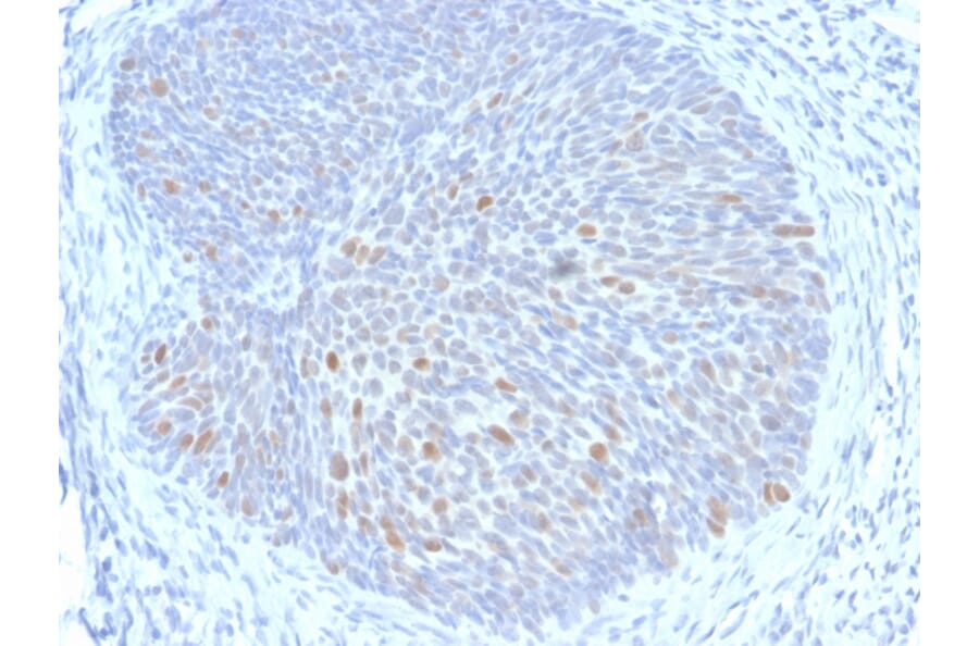 Immunohistochemistry - Anti-HPV16 E1 + E4 Antibody [HPV16 E1/E4] (A251002) - Antibodies.com