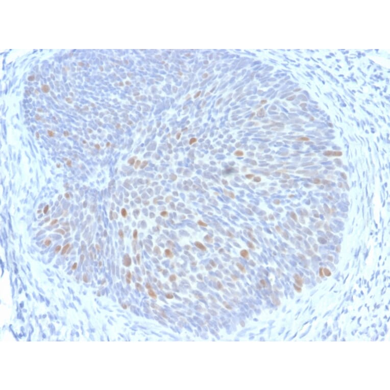 Immunohistochemistry - Anti-HPV16 E1 + E4 Antibody [HPV16 E1/E4] (A251002) - Antibodies.com