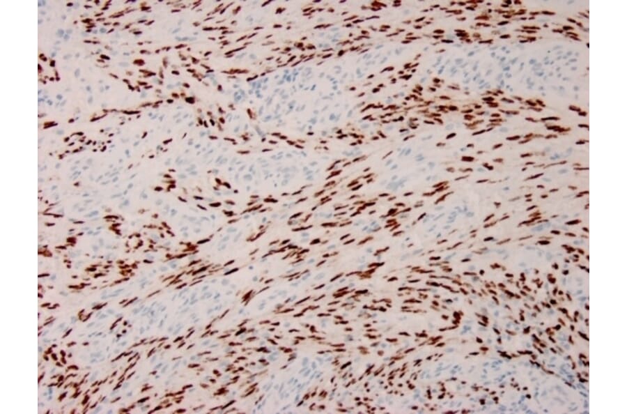 Immunohistochemistry - Anti-HHV8 LNA-1 Antibody [HHV8/3633R] (A251016) - Antibodies.com