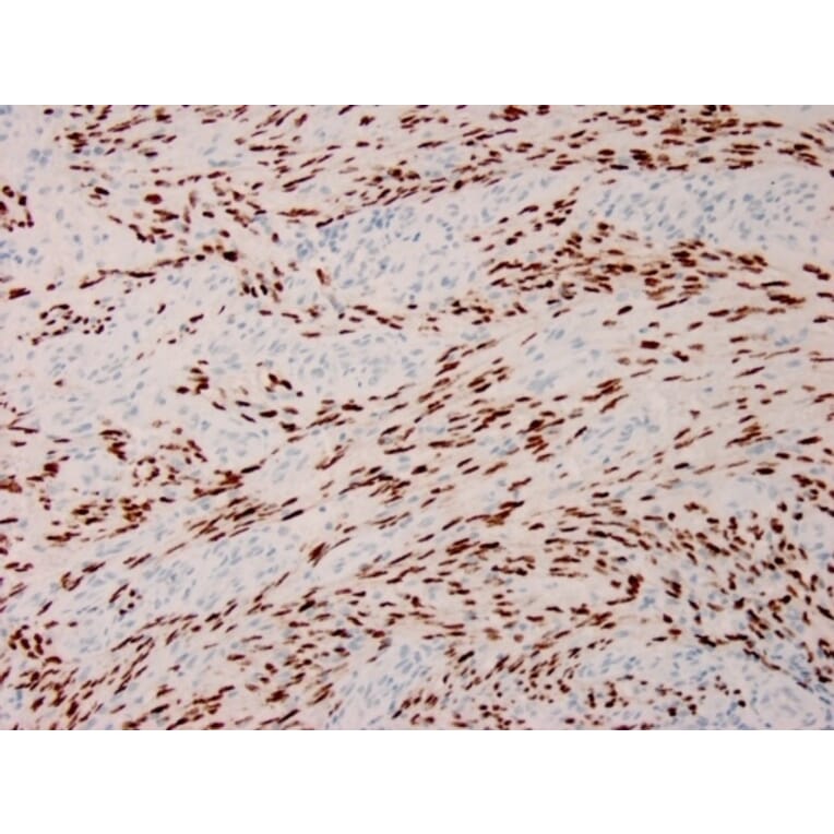 Immunohistochemistry - Anti-HHV8 LNA-1 Antibody [HHV8/3633R] (A251016) - Antibodies.com