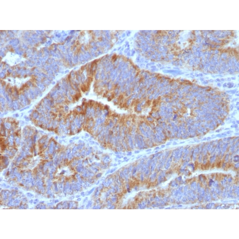 Immunohistochemistry - Anti-Thomsen-Friedenreich Antigen Antibody [SPM320] (A251091) - Antibodies.com