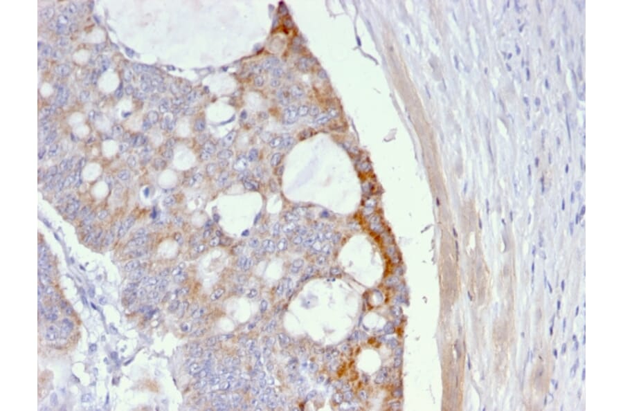Immunohistochemistry - Anti-Thomsen-Friedenreich Antigen Antibody [A63-C/A9] (A251097) - Antibodies.com