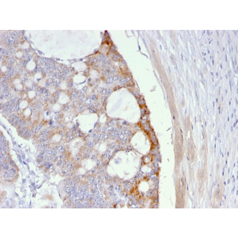 Immunohistochemistry - Anti-Thomsen-Friedenreich Antigen Antibody [A63-C/A9] (A251097) - Antibodies.com
