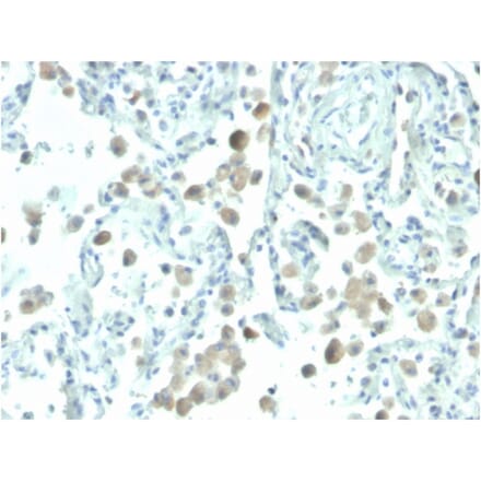 Immunohistochemistry - Anti-Mesothelin Antibody [MSLN/2131] (Biotin) (A251214) - Antibodies.com