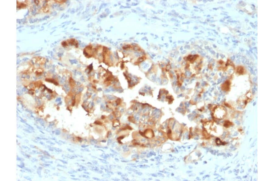 Immunohistochemistry - Anti-Mesothelin Antibody [MSLN/2131] - BSA and Azide free (A251261) - Antibodies.com
