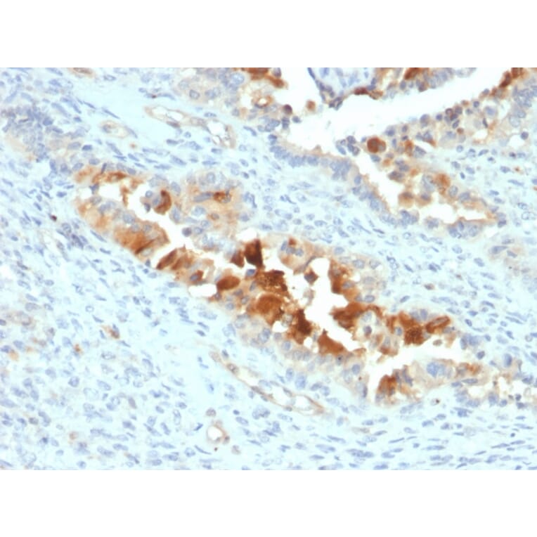 Immunohistochemistry - Anti-Mesothelin Antibody [SPM143] - BSA and Azide free (A251261) - Antibodies.com