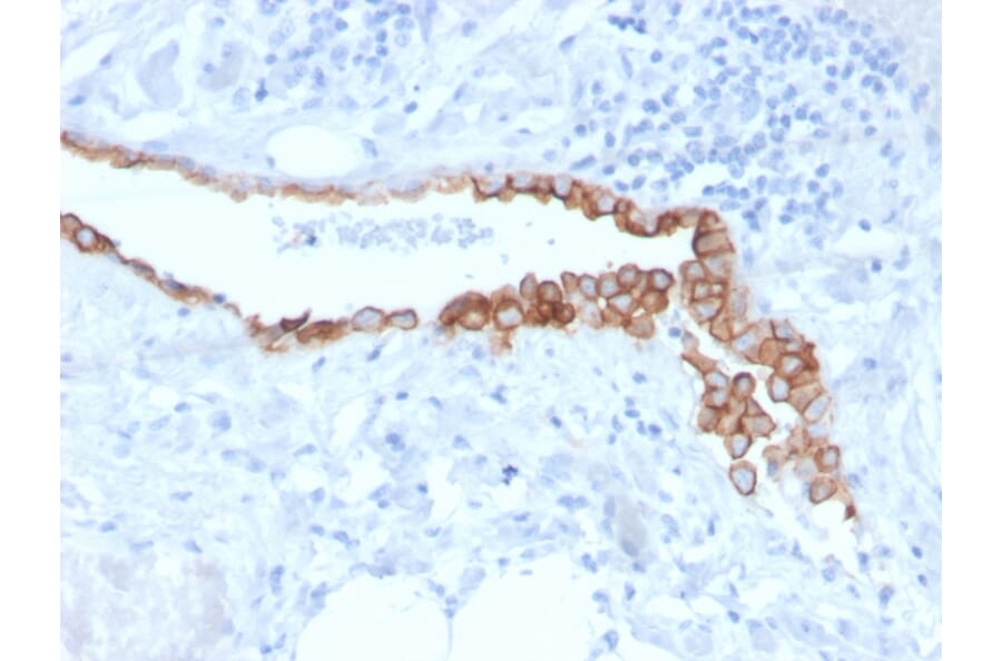 Immunohistochemistry - Anti-Mesothelin Antibody [MSLN/3384] - BSA and Azide free (A251263) - Antibodies.com